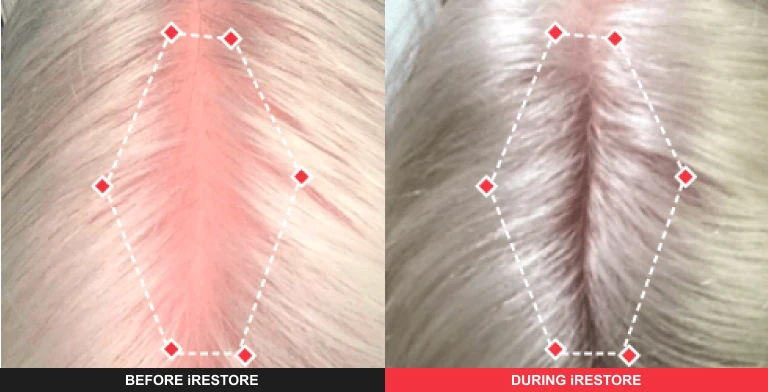 Comparison image of before and after using iRESTORE hair device