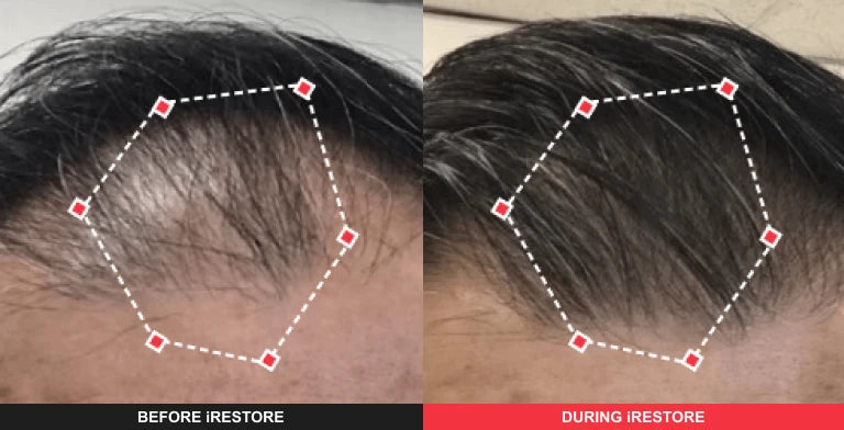 Comparison image of before and after using iRESTORE hair device