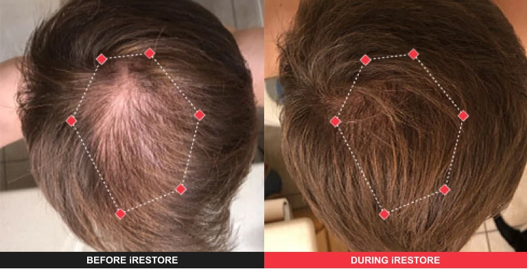 Comparison image of before and after using iRESTORE hair device