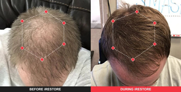 Comparison image of before and after using iRESTORE hair device