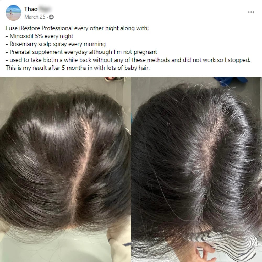 A facebook post from Thao on March 25th. I use iRestore Professional every other night along with Minoxidil 5% every night, Rosemarry scalp spray every morning, Prenatal supplement everyday although I'm not pregnant, used to take biotin a while back without any of these methods and did not work so I stopped. This is my result after 5 months in with lots of baby hair. This post shows before and after images with the before showing thinning at the hairline and the after showing thicker hair line.