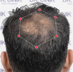 Top down view before image of a man with thinning hair at his crown.