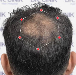 Top down view before image of a man with thinning hair at his crown.