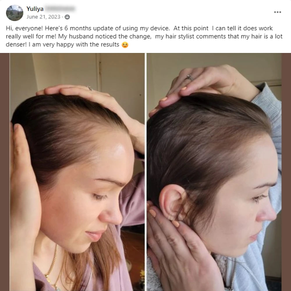 A facebook post from Yuliya on June 21st of 2023. Hi, everyone! Here's 6 months update of using my device.  At this point I can tell it does work really well for me! My husband noticed the change, my hair stylist comments that my hair is a lot denser. I am very happy with the results. This post shows before and after images with the before showing a thinning temple of a woman and the after showing her temples that got thicker hair.