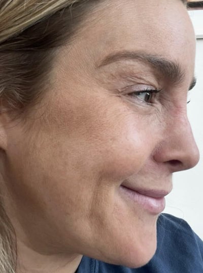 Side view after image of woman with lesser wrinkles and fine lines after 3 months of usage