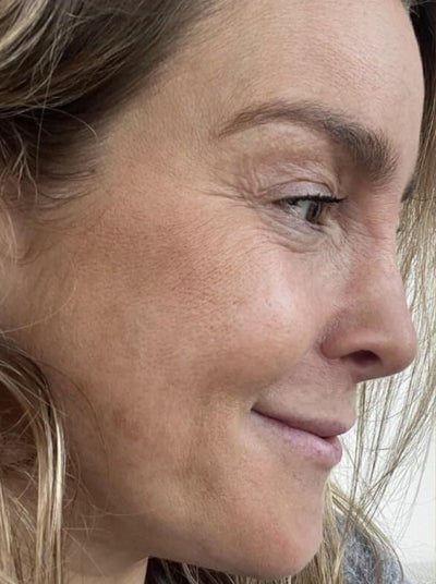 Side view before image of woman with visible wrinkles and fine lines