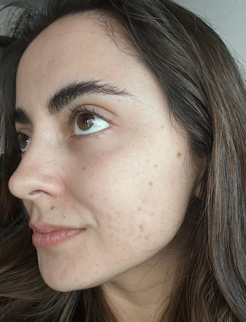 woman's face after using illumina led face mask