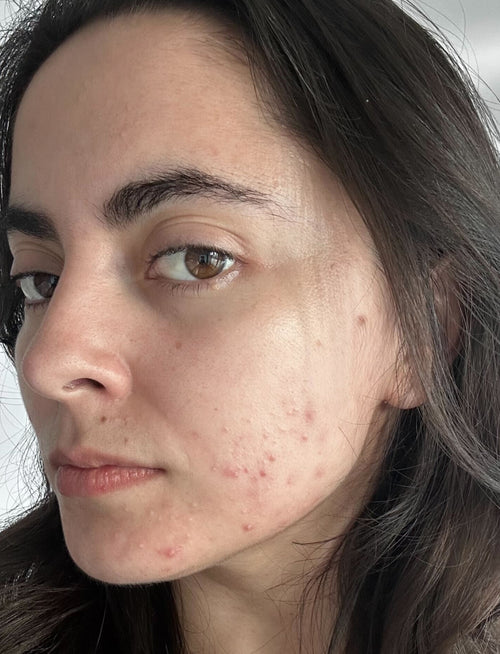 woman's face before using illumina led face mask
