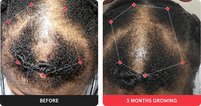 Before and after image. On the left is the before image of woman with thinning crown. On the right is image of woman with thicker hair after 3 months. 