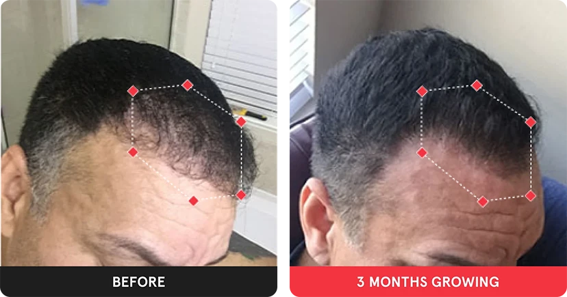 Before and after image. On the left is the before image of man with thinning hair at the temples. On the right is image of man with thicker hair after 3 months. 