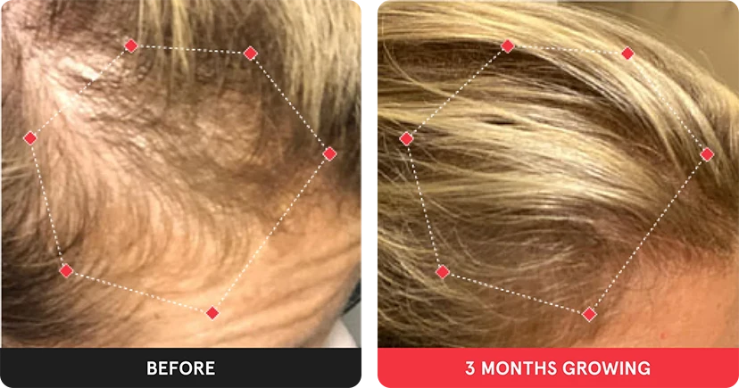 Before and after image. On the left is the before image of woman with thinning hair at her temples. On the right is image of a woman with thicker hair after 3 months. 