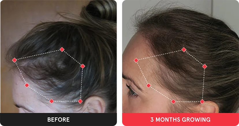 Before and after image. On the left is the before image of woman with thinning hair at her temples. On the right is image of a woman with thicker hair after 3 months. 