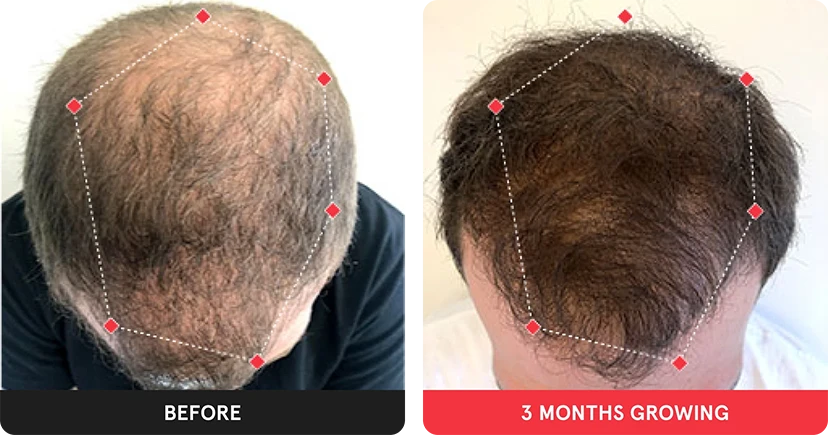 Before and after image. On the left is the before image of man with thinning hair in the frontal region and crown. On the right is image of man with thicker hair after 3 months. 