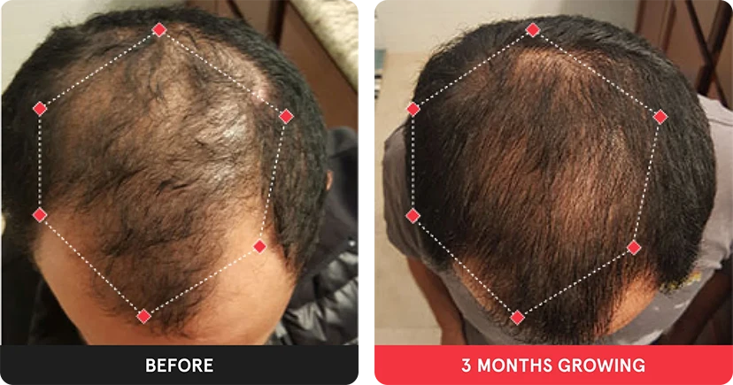 Before and after image. On the left is the before image of man with thinning hair in the frontal region and crown. On the right is image of man with thicker hair after 3 months. 