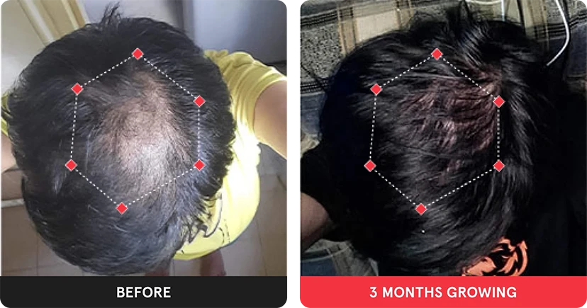 Before and after image. On the left is the before image of woman with thinning hair in the  crown. On the right is image of woman with thicker hair after 3 months. 