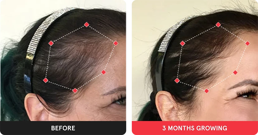 Before and after image. On the left is the before image of woman with thinning hair at her temples. On the right is image of a woman with thicker hair after 3 months. 