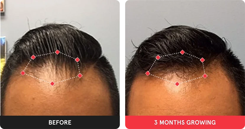 Before and after image. On the left is the before image of man with thinning hair in the frontal region. On the right is image of man with thicker hair after 3 months. 