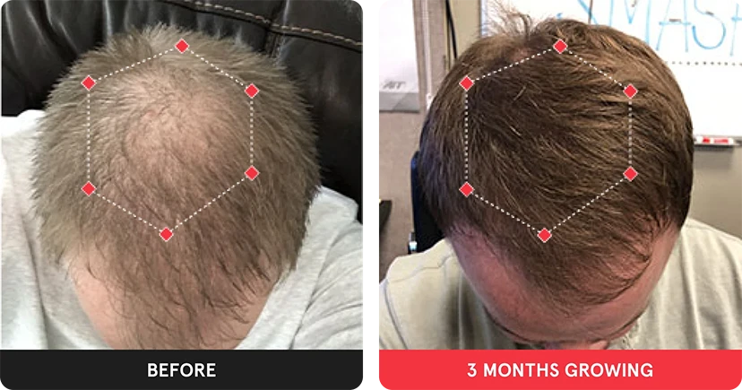 Before and after image. On the left is the before image of man with thinning hair in the  crown. On the right is image of man with thicker hair after 3 months. 