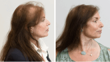 GIF showing a few before and after images with visible progress showing hair growth.