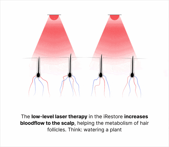 Short animated clip showing how lasers and LEDs penetrates to scalp. The low-level laser therapy in the iRESTORE increases blood flow to the scalp, helping the metabolism of hair follicles. Think, watering a plant.