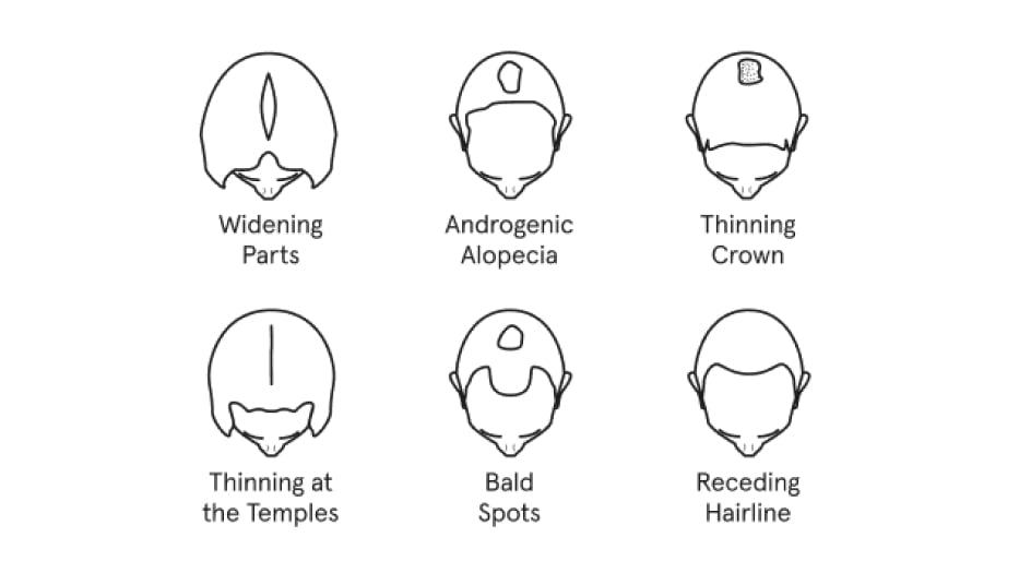 Illustration showing the different types of hair loss, such as Widening Part, Androgenic Alopecia, Thinning Crown, Thinning at the Temples, Bald Spots and Receding Hairline.