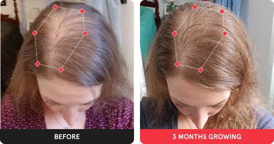 Before and after image. On the left is the before image of woman with thinning hair in her hairline. On the right is image of woman with thicker hair after 3 months. 