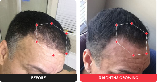 Before and After showing significant growth after using iRESTORE device for 5 months