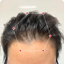 Top view of a person's hairline with a pentagon shape marked by red points.