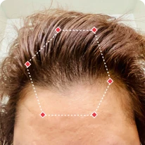 Close-up of a person's hairline, outlined with a dotted hexagon.