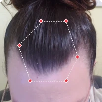 A person's forehead with hair tied back, highlighting a hexagonal area.