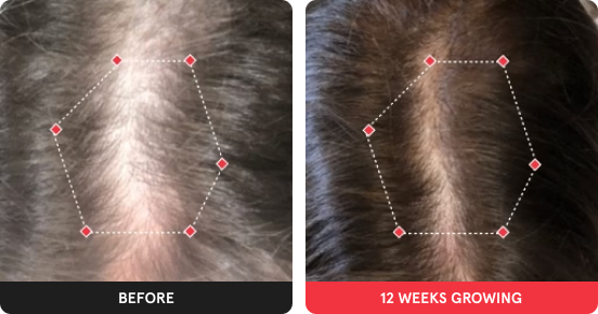 before and after showing significant hair growth