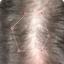Close-up of parting in hair with a pentagon shape marked by dotted lines and red points.