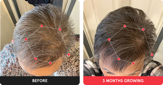 Before and after image. On the left is the before image of woman with thinning hair in the frontal region of her hair. On the right is image of woman with thicker hair after 3 months. 