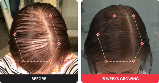 Before and After showing significant growth after using iRESTORE device for 15 weeks