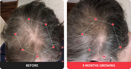 Before and After showing significant growth after using iRESTORE device for 5 months