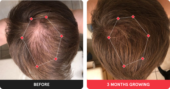 Before and after image. On the left is the before image of man with thinning hair in his crown. On the right is image of woman with thicker hair after 3 months. 