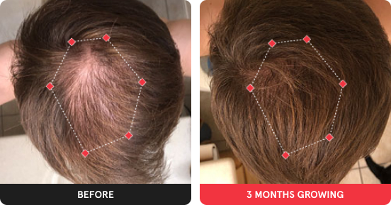 Before and After showing significant growth after using iRESTORE device for 3 months