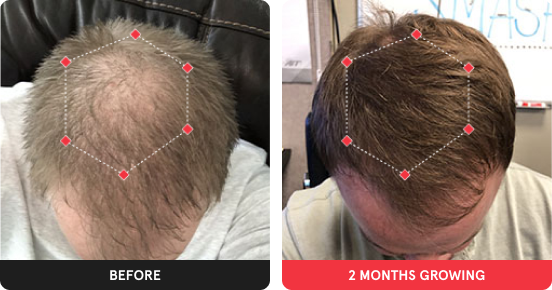 Before and After showing significant growth after using iRESTORE device for 15 weeks