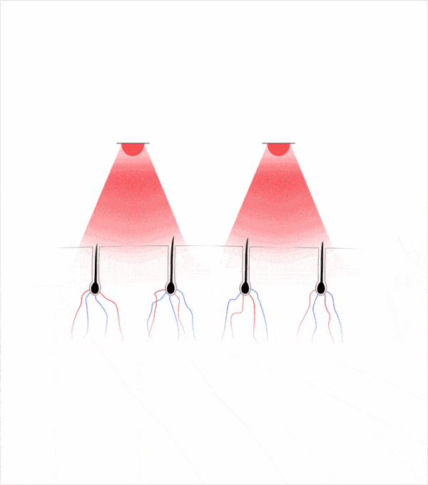 Short animated clip showing how lasers and LEDs penetrates to scalp.
