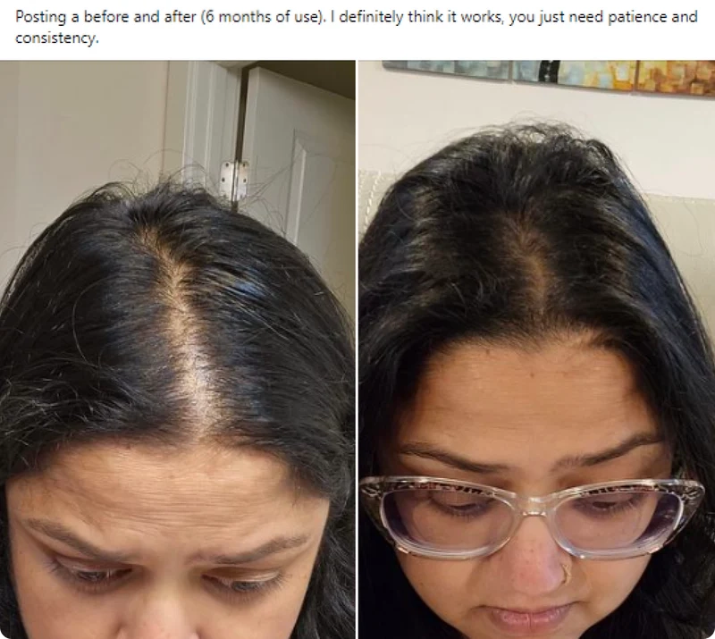 Before and after comparison of hair growth over six months on a woman's scalp.