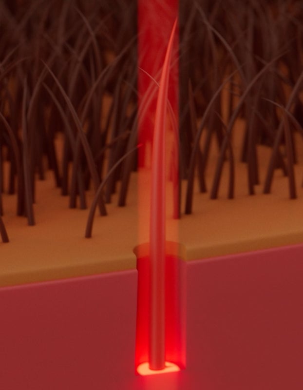 Animated image of laser penetrating the scalp.