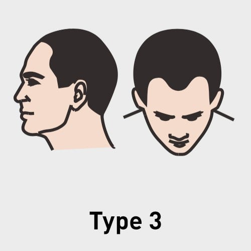 Type 3