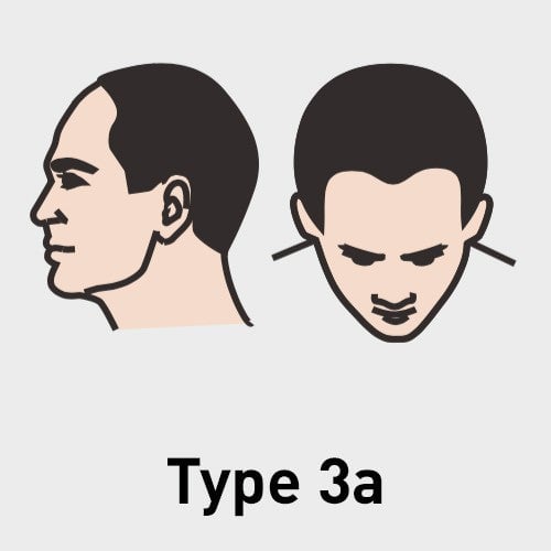 Type 3a