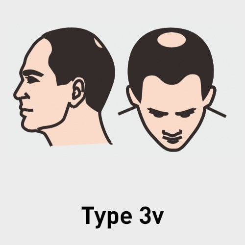 Type 3v