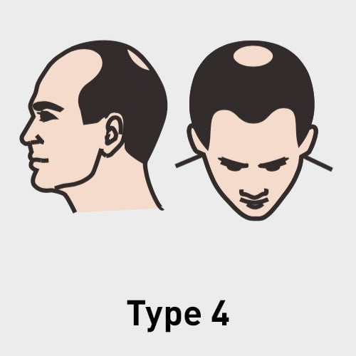 Type 4