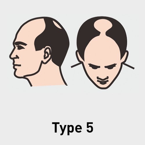 Type 5
