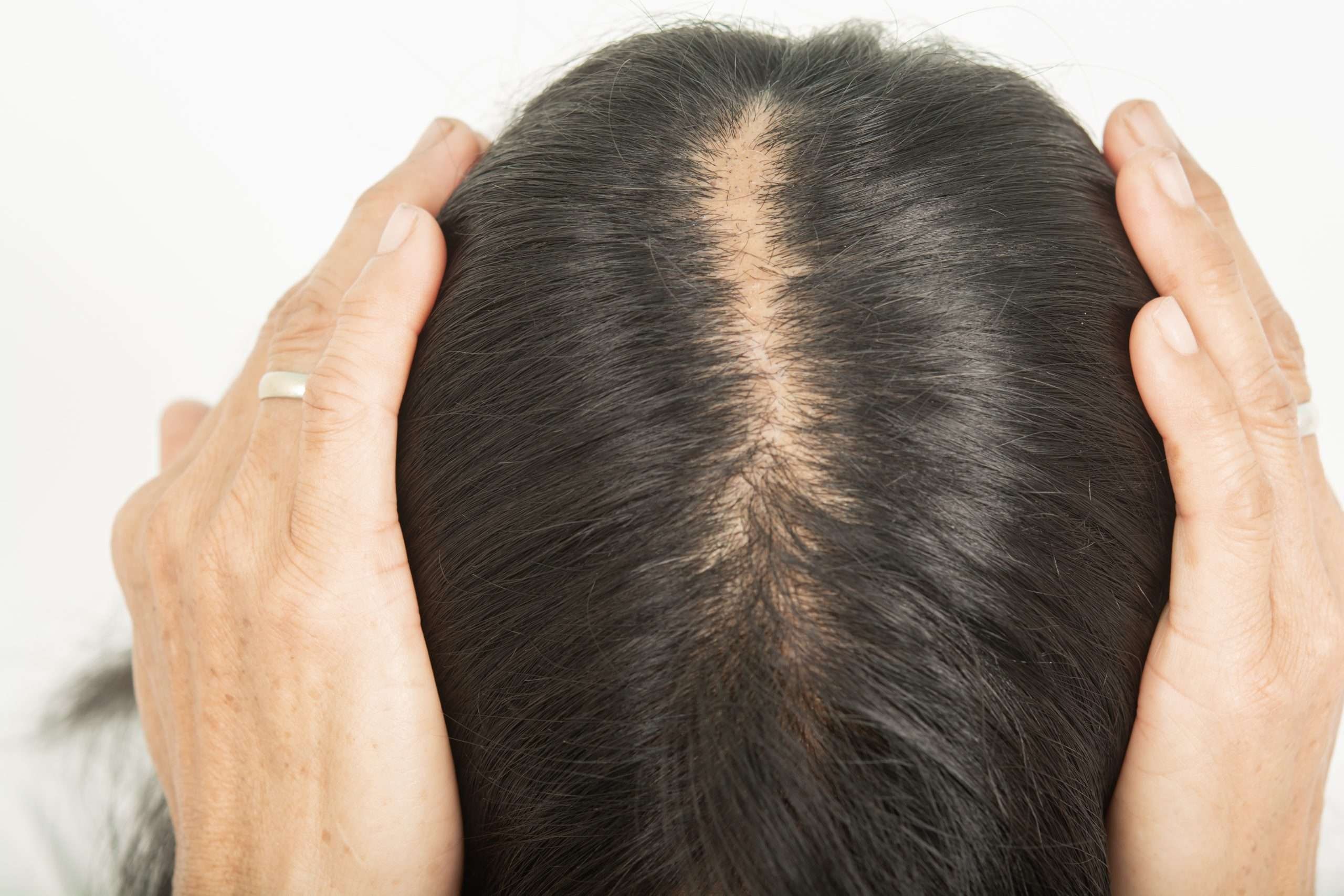 woman holding hair exposing a widening hair gap and scalp